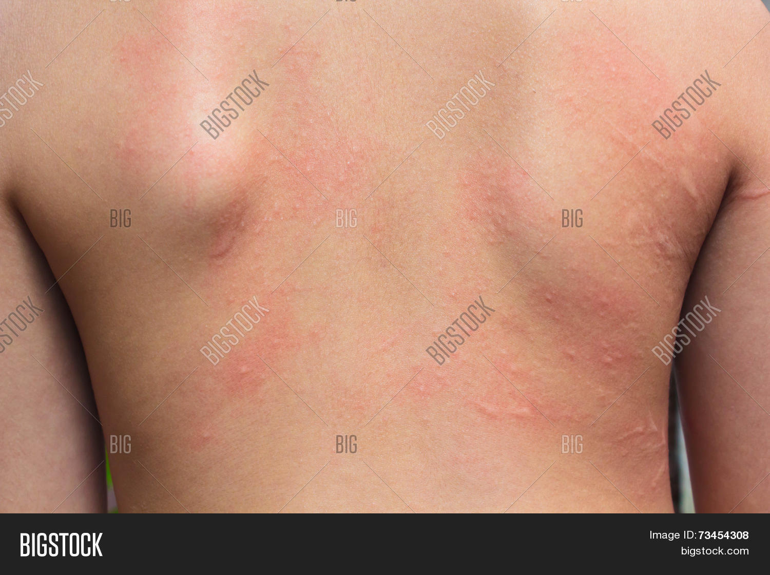 Allergic Rash Image & Photo (Free Trial) | Bigstock