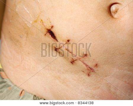 Dodatek odstranění šicí