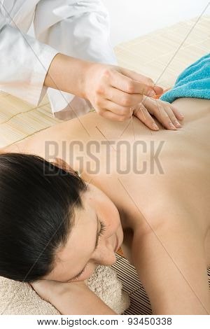 Acupuncture