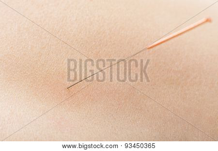 Acupuncture