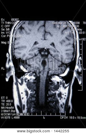 Todellinen Mri / Mra (magneettikuvaus varjoainekuvauksessa) aivojen verisuoniston