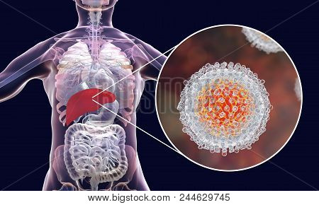 Hepatitis C Virus Infection Medical Concept, 3d Illustration