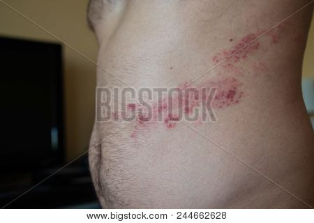 Close Up On Herpes Zoster On The Stomach
