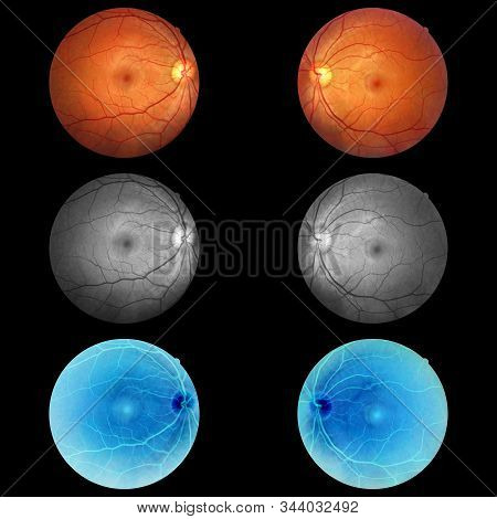 Human Eye Anatomy Taking Images With Mydriatic Retinal Cameras
