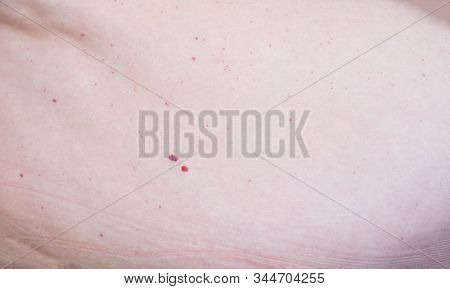 Red Moles Of Nevi On The Abdomen In Humans, Hemangioma