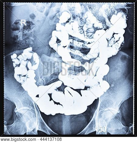 X-ray Radiogram With Barium Study Of Small Bowel After 150 Minutes (two And Half Hours) After The St