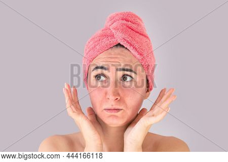 Sad Face Of Young Woman With Skin Irritation, Redness, Skin Problems, Acne, Rash Or Sunburn On Gray 