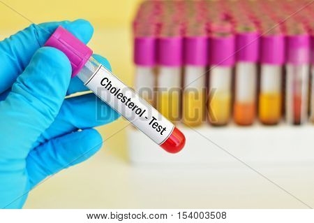 Test tube with blood sample for cholesterol test