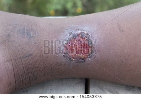 Infected wound on leg with selective and soft focus.