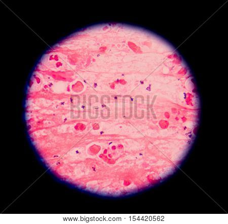 Gram Stain Showing Blue Cells Gram Positive In Single,in Pair,in Cluster Intracellular On Red White