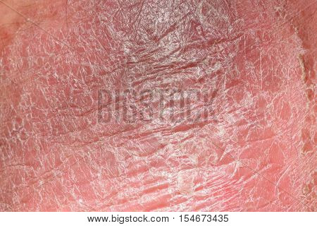 Psoriasis Skin. Psoriasis Is An Autoimmune Disease That Affects The Skin Cause Skin Inflammation Red