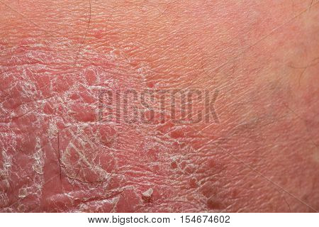 Psoriasis skin. Psoriasis is an autoimmune disease that affects the skin cause skin inflammation red and scaly.