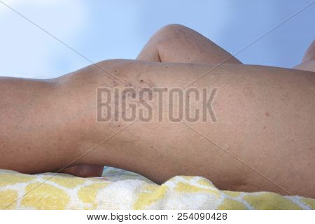 Swollen Blood Vessels On Female Mature Legs