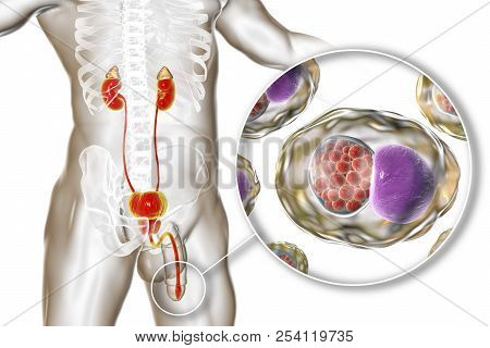 Chlamydiosis Infection In Man, 3d Illustration Showing Close-up View Of Chlamydia Trachomatis Bacter