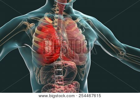 Pneumonia Medical Concept, 3d Illustration Showing Lobar Pneumonia Of The Right Lung