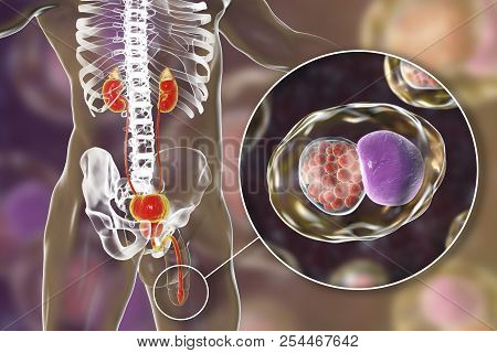 Chlamydiosis Infection In Man, 3d Illustration Showing Close-up View Of Chlamydia Trachomatis Bacter