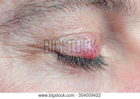 Chalazion On The Eyelid Of A Man Close-up.
