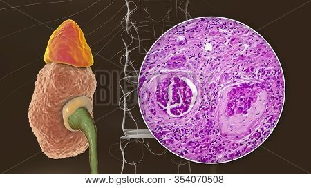 Chronic Glomerulonephritis, 3d Illustration Showing Pale Contracted Coarsely Granular Kidneys And Li