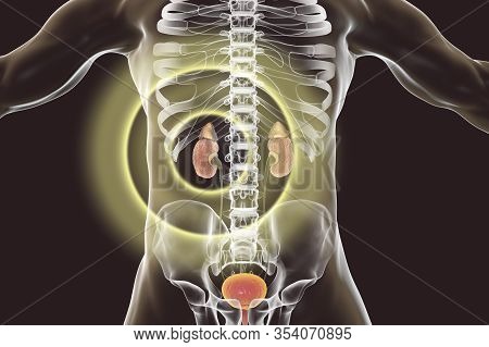 Chronic Glomerulonephritis, Gross Pathology, Scientifically Accurate 3d Illustration Showing Pale Co