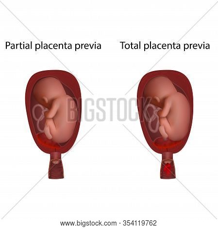 Partial And Total Placenta Previa. Fetus In Uterus, Womb, Placenta, Umbilical Cord. Hi-risk Pregnanc