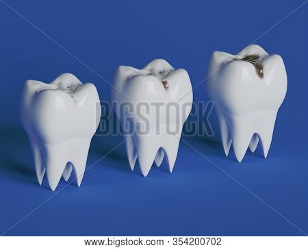 Three Stages Of Tooth Decay, Caries. 3d Illustration