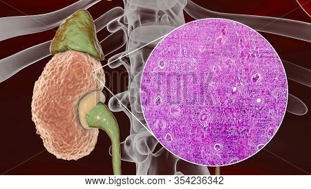 Chronic Glomerulonephritis, 3d Illustration Showing Pale Contracted Coarsely Granular Kidneys And Li