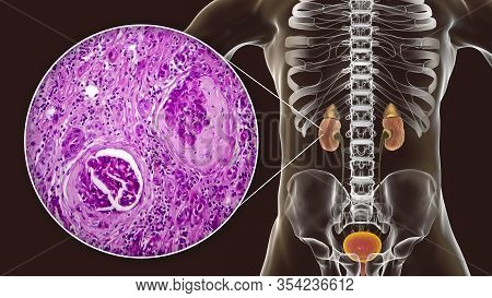 Chronic Glomerulonephritis, 3d Illustration Showing Pale Contracted Coarsely Granular Kidneys And Li