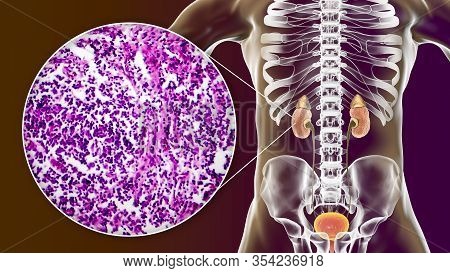 Chronic Glomerulonephritis, 3d Illustration Showing Pale Contracted Coarsely Granular Kidneys And Li