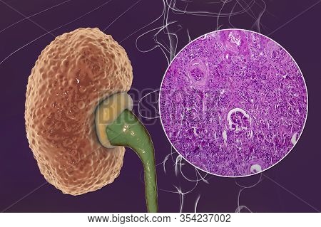 Chronic Glomerulonephritis, 3d Illustration Showing Pale Contracted Coarsely Granular Kidneys And Li