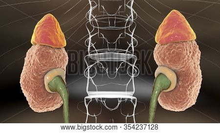 Chronic Glomerulonephritis, Gross Pathology, Scientifically Accurate 3d Illustration Showing Pale Co