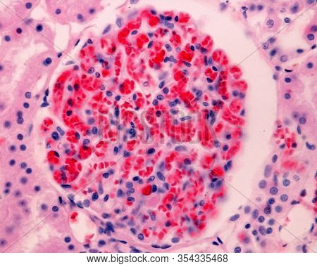 Glomerulus Affected By A Severe Capillary Congestion. The Glomerular Capillaries Are Full Of Red Blo