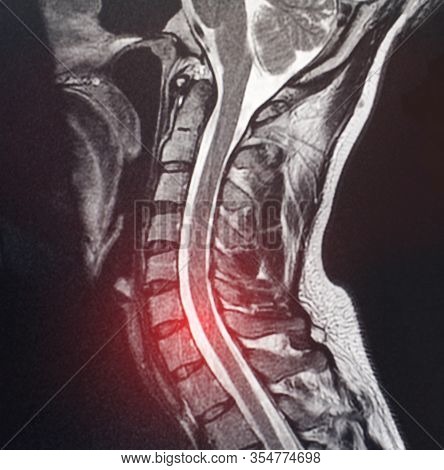 Magnetic Resonance Image Of The Cervical Spine Of A Patient Who Has Pain And Numbness In The Neck. T