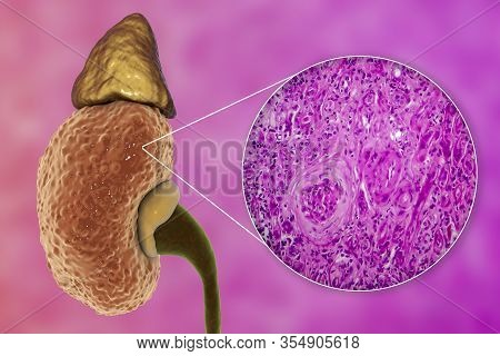 Chronic Glomerulonephritis, 3d Illustration Showing Pale Contracted Coarsely Granular Kidneys And Li