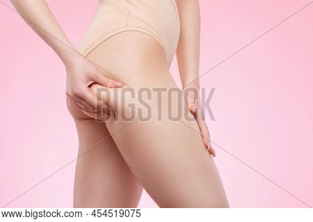 The Girl Stretches The Skin On Her Leg, Showing Fat Deposits And Cellulite. The Concept Of Weight Lo