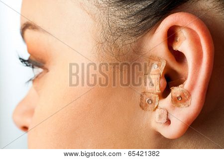 Auriculotherapy On Female Ear.