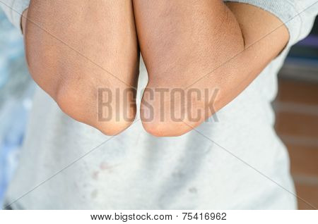 Elbow Of Patients With Gout.