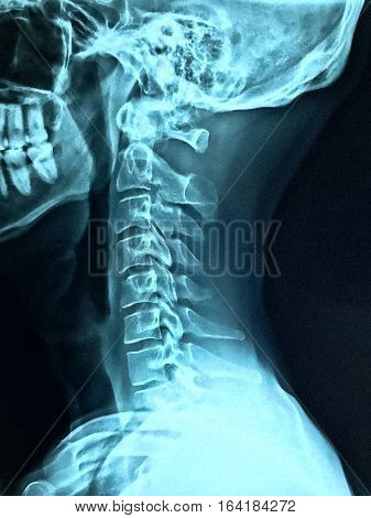 X-ray of Neck Cervical sprain rectification of lumbar lordosis