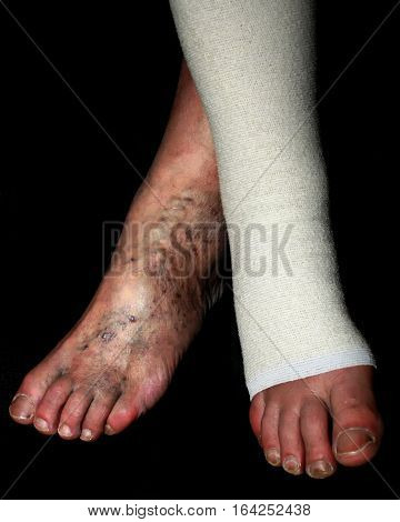 Leg. Varicose  veins. Phlebeurysm. Thrombophlebitis. Elastic bandage