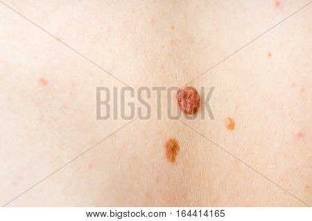 Woman With Birthmark On Her Back