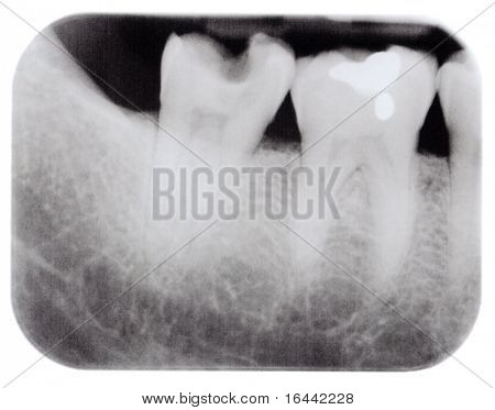 แสง x Molars กับผุ