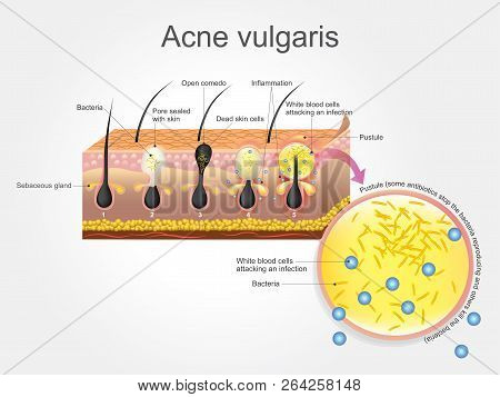 Acne Vulgarise Is A Long-term Skin Disease That Occurs When Hair Follicles Become Clogged With Dead 