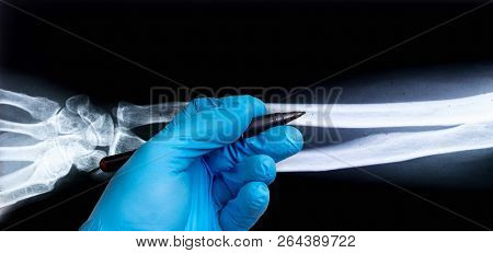 X-ray Of Human Arm With Doctor's Hand In Glove