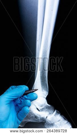 X-ray Of Human Leg With Doctor's Hand In Glove