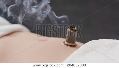 Chinese traditional medicine moxibustion therapy 
