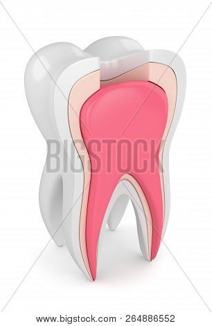 3D Render Of Tooth With Root Canal Treatment Procedure