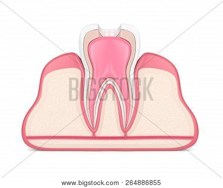 3D Render Of Tooth With Root Canal Treatment Procedure