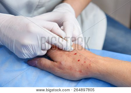 Plasmolifting Hands. Injections For Rejuvenation And Skin Regurgitation From Human Plasma. A Modern 