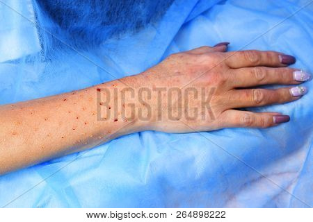 Plasmolifting Hands. Injections For Rejuvenation And Skin Regurgitation From Human Plasma. A Modern 