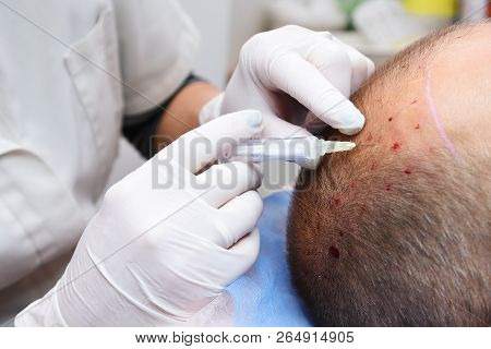 Treatment Of Baldness With Beauty Injections. Mesotherapy. Plasmalifting.
