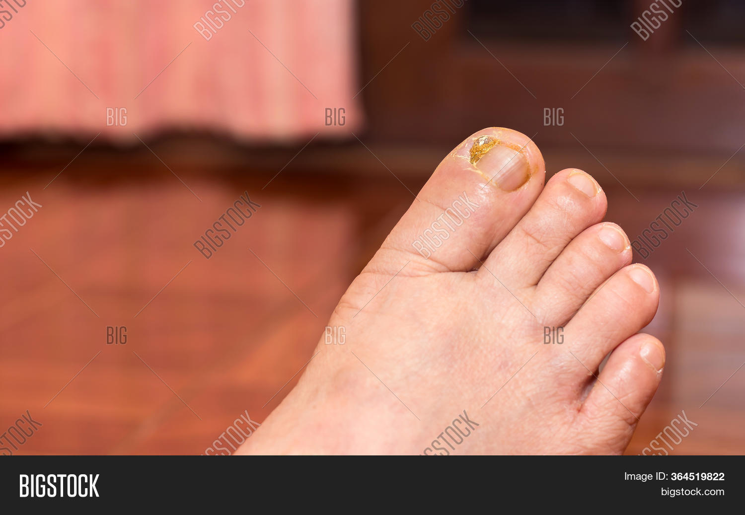 Nail Sores On Toes, Image & Photo (Free Trial) Bigstock